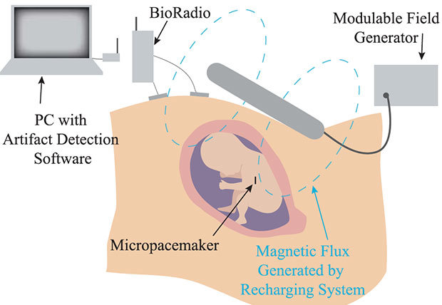 دستگاه پیس‌ میکر برای کنترل ریتم تپش قلب جنین در داخل رحم ساخته شد